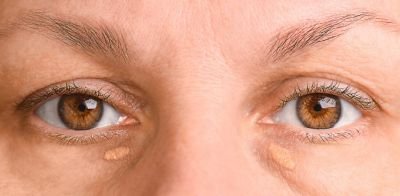 Manchas ao redor dos olhos acendem alerta de risco de infarto e derrame